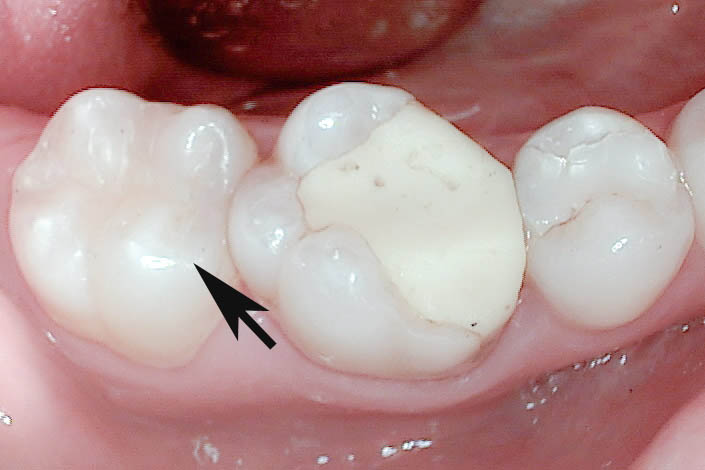 Zahnfarbene Füllungen - Zahnarztpraxis Dr. Becker & Dr. Kubitza