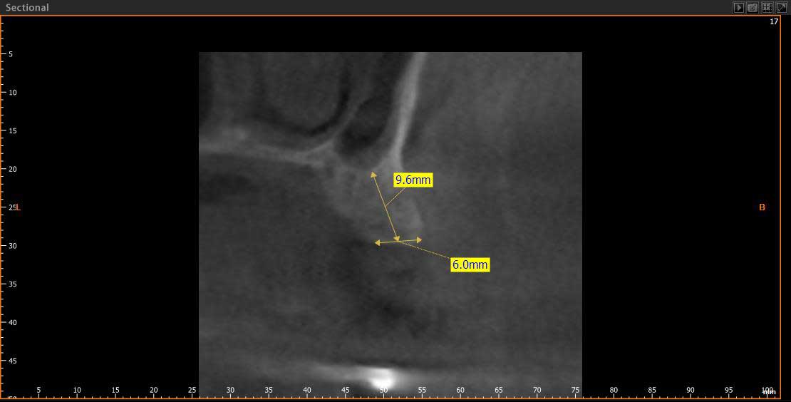 Simulation eines Implantats beim Zahnarzt in Lauchringen